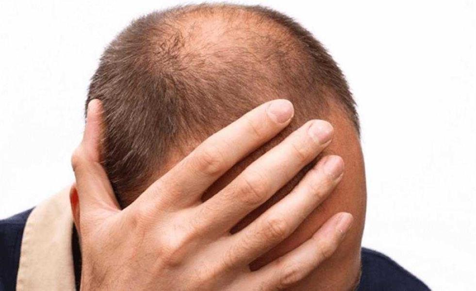 اختراع نوعي لمكافحة الصلع اختراع نوعي لمكافحة الصلع
