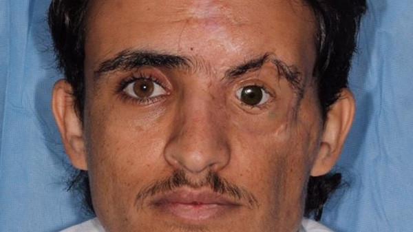 فريق طبي بمدينة الملك فهد ينجح في زراعة عين اصطناعية وعظام الوجه لمريض فريق طبي بمدينة الملك فهد ينجح في زراعة عين اصطناعية وعظام الوجه لمريض